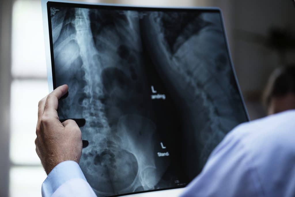 Chiropractor examining x-rays of a spine that is out of alignment.